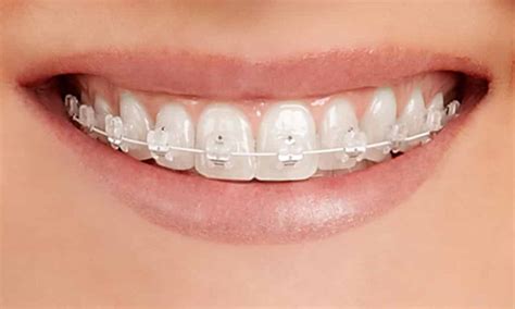 Clear Ceramic Braces | SKS Orthodontics: Proudly Serving Fayetteville ...