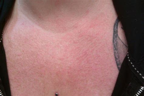 Red Spots On Chest Back And Neck at John Lay blog