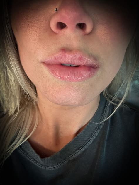 How Long Does Lip Filler Swelling Last? A Frankfort Med Spa Guide