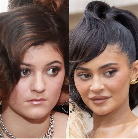 plastic surgery celebrity plastic surgery kylie