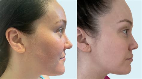 I tried HIFU facial laser to minimise my double chin