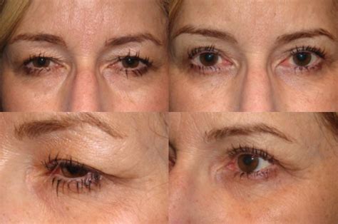 Blepharoplasty - Pictures