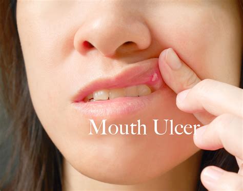 What Causes Mouth Ulcers Repeatedly - Infoupdate.org