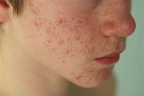 Images of 15 Common Skin Diseases in Adults