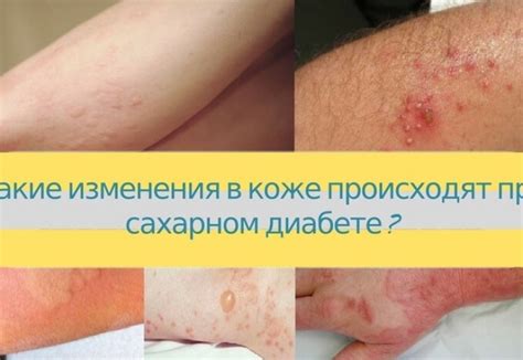 Какие изменения в коже происходят при сахарном диабете? - Estet-Portal
