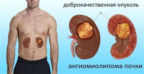 Ангиомиолипома почки (левой, правой): что это, лечение