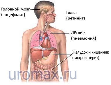 Цитомегаловирусная инфекция человека - ЦИЧ