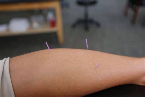 dry needling physical therapy kent medina rootstown montrose