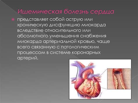 ИБС: нестабильная стенокардия - презентация онлайн