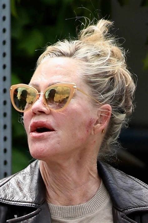 Melanie Griffith con extraños moretones en su cara y manos
