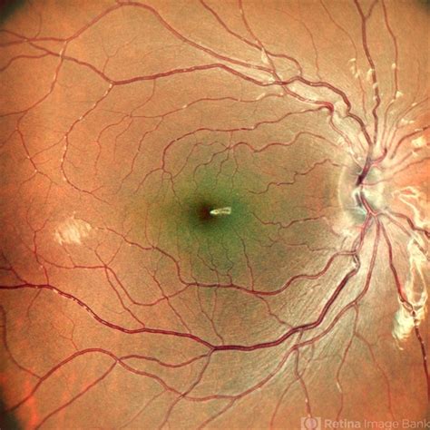 AMBLYOPIA - Retina Image Bank