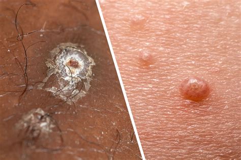 genital warts   thigh