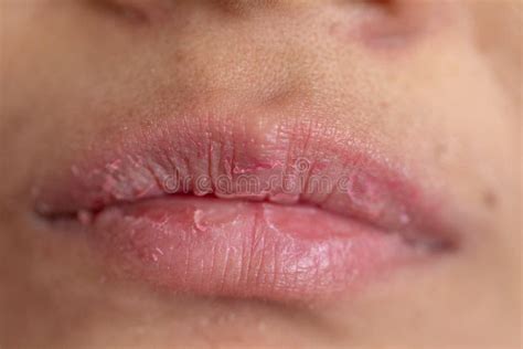 Crusty Lips