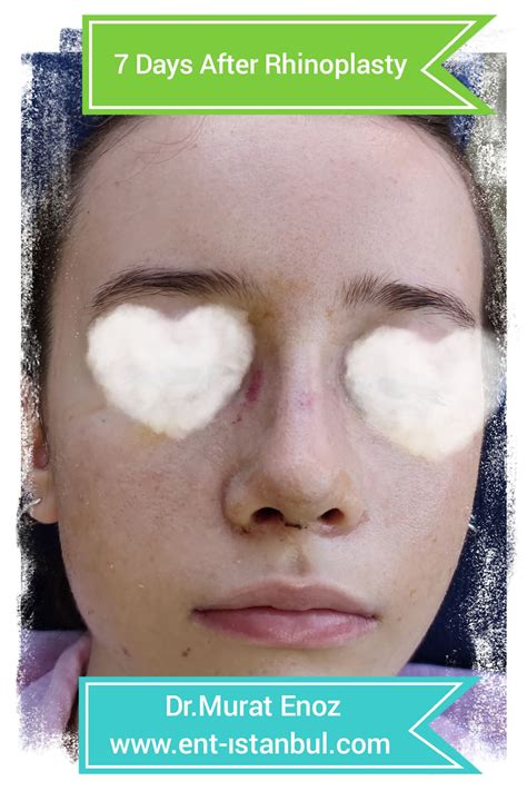 Brief Information About The Factors Affecting the Amount of Bruising