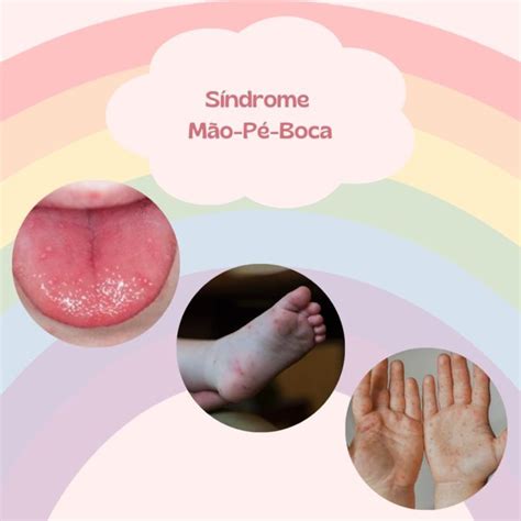 Mão-pé E Boca Em Bebê Fotos - Mãos, Pés e Boca - Afinal o que é? - Clínica Crescendo