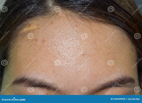 oily skin  wide forehead  asian adult young woman stock photo