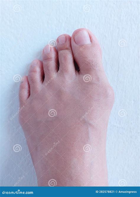 A Woman Left Foot with Hallux Valgus, Foot Bunions. Stock Image - Image