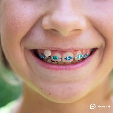 braces colors   pick   color   braces
