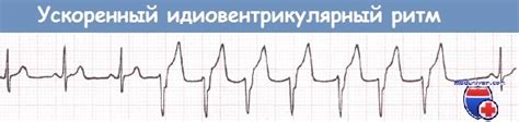 Желудочковая тахикардия (ЖТ) при инфаркте миокарда