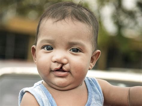 operation smile controversy 2