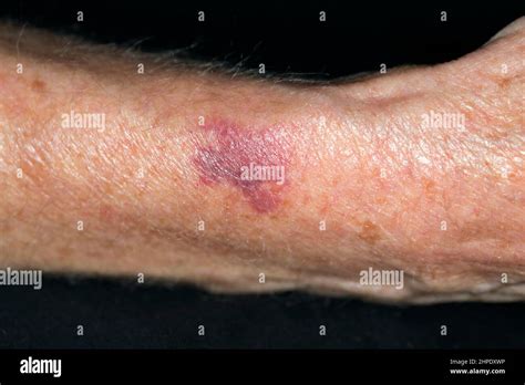 Purpura hi-res stock photography and images - Alamy
