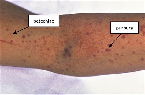 O Que É Purpura No Sangue - Sangue Cor De Purpura - RETOEDU