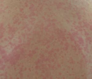 Viral Exanthem Rash - Pictures, Treatment, Symptoms,