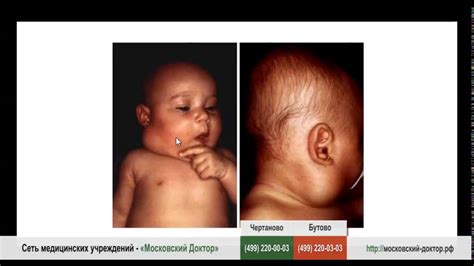 Лимфангиома у новорожденного - YouTube