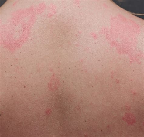 13 Surprising & Common Skin Indicators of Diabetes - Diabetes Fixer