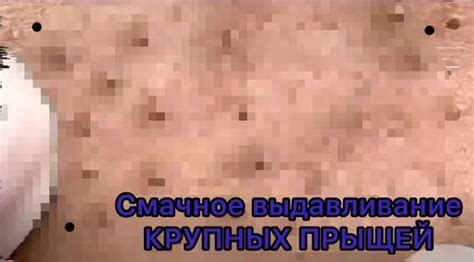 Жирное, смачное выдавливание крупных Комедонов, Прыщей, Акне ...