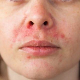 Perioral Dermatitis - Dermatologist in Fresno, CA | Intelligent Skincare