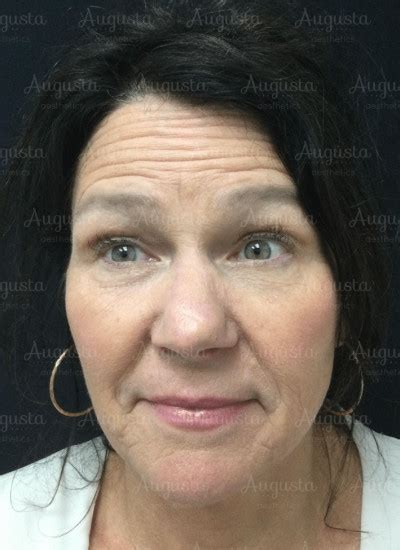 Botox Before and After - Augusta Aesthetics