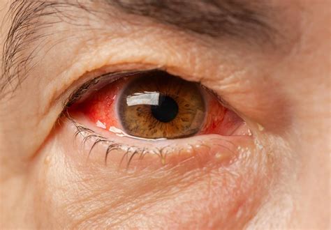 Subconjunctival Hemorrhage: Symptoms, Causes, Treatment