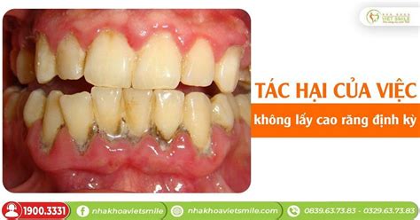 bang gia lay cao rang tai viet smile