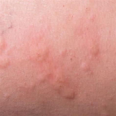 How to identify 4 common skin rashes – Artofit