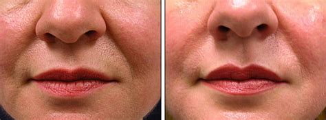 Collagen & Hyaluronic Acid Injections | Before and After Pictures ...