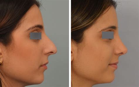 nose job Los Angeles | Nose job, Rhinoplasty, Nose surgeon