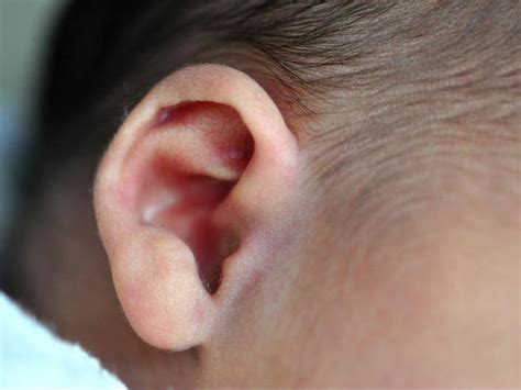 Ear Infection (Outer Ear) Care Plan - Planning for Care