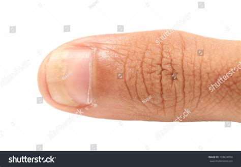 Fingernail Fungus Isolated On White Background Stock Photo (Edit Now ...