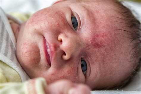 Tratamiento del acné neonatal - Eres Mamá Enfermedades en el bebé
