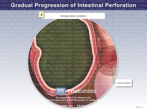 Gradual Progression of Intestinal Perforation: Intraoperative Con...