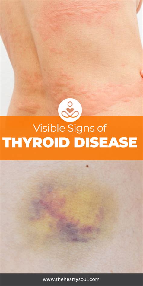 Skin Signs of Thyroid Disease (With images) | Thyroid disease, Thyroid ...