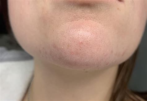 [Skin Concern] What is this breakout on my chin? Started off as a lot