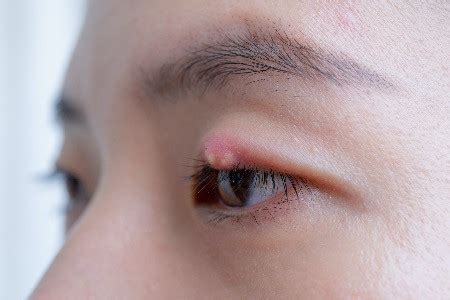 Chalazion Removal London | Chalazion Treatment | Ahmad Aziz