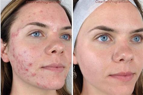 Clear Path Acne Clinic - Cedar Park - Book Online - Prices, Reviews, Photos