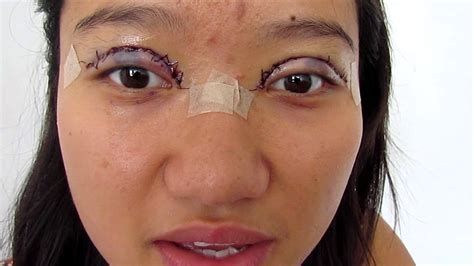 After-Care Tips After Eye Surgery: What To Expect And How To Recover