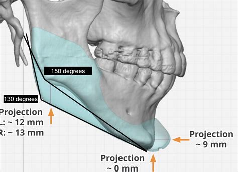 Change in Gonial Angle with Vertical Jaw Angle Lengthening Dr Barry