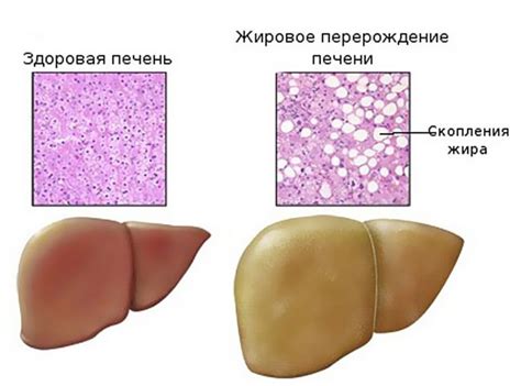 Ожирение печени: симптомы, диагностика, лечение
