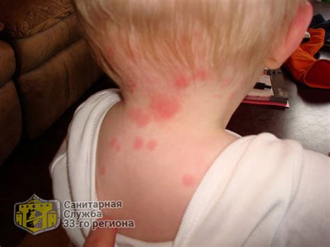 Укусы постельных клопов на теле человека. Симптомы, отличия, лечение.