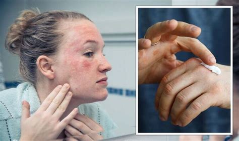 Steroid cream: Expert issues warning for long-term use - 'Side effect ...